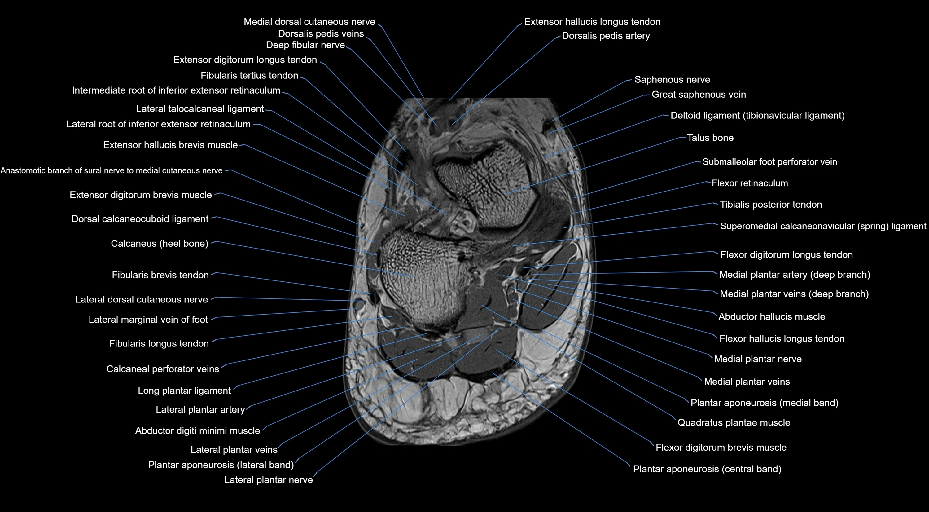 MRI mid foot coronal ligaments cross sectional anatomy 3T  radiology  image-img-00001-00040.webp